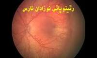 وبینار «رتینوپاتی نوزادان نارس (ROP)» در دانشگاه علوم پزشکی گیلان برگزار می شود