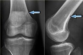 کنفرانس علمی تومورهای خوش خیم و بدخیم استخوان در دانشگاه علوم پزشکی گیلان برگزار می شود